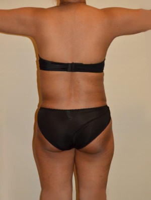 Liposuction Case 13021 After Photo Liposuction