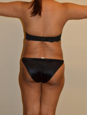 Liposuction Case 13021 Before Photo Liposuction