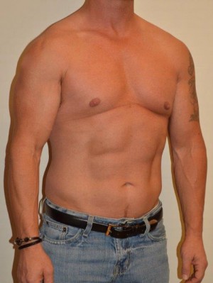 Male Pectoral Implants Case 13022 Before Photo Male Pectoral Implants