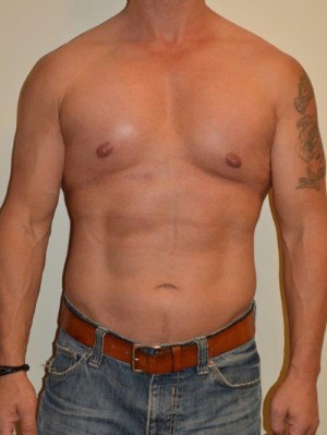 Male Pectoral Implants Case 13022 After Photo Male Pectoral Implants