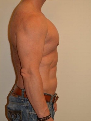Male Pectoral Implants Case 13022 After Photo Male Pectoral Implants
