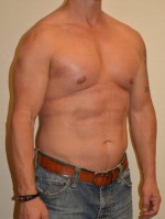 Male Pectoral Implants