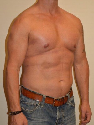 Male Pectoral Implants Case 13022 After Photo Male Pectoral Implants
