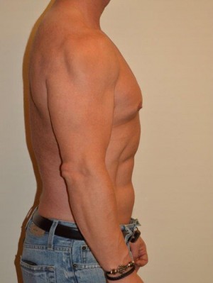 Male Pectoral Implants Case 13022 Before Photo Male Pectoral Implants