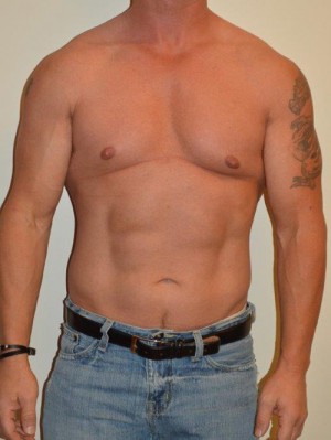 Male Pectoral Implants Case 13022 Before Photo Male Pectoral Implants