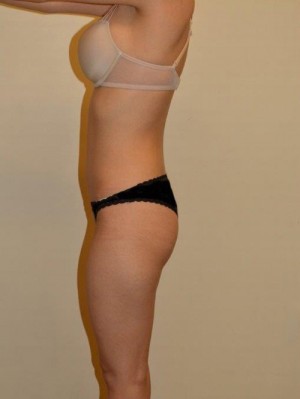 Buttock Augmentation Case 13041 Before Photo Buttock Augmentation