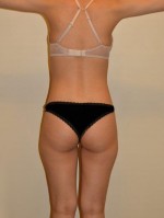 Buttock Augmentation