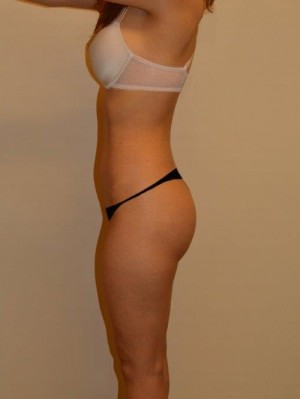 Buttock Augmentation Case 13041 After Photo Buttock Augmentation