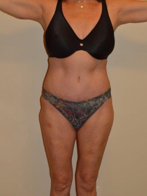 Tummy Tuck Case 13065 After Photo Tummy Tuck