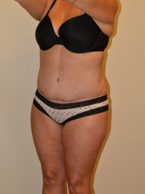 Tummy Tuck Case 13066 After Photo Tummy Tuck