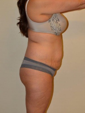 Liposuction Case 13067 Before Photo Liposuction
