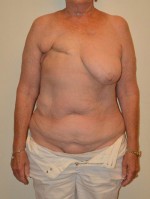 Breast Reconstruction