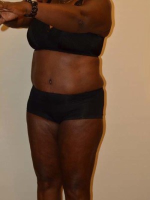 Tummy Tuck Case 13131 After Photo Tummy Tuck