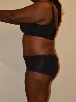 Tummy Tuck Case 13131 After Photo Tummy Tuck