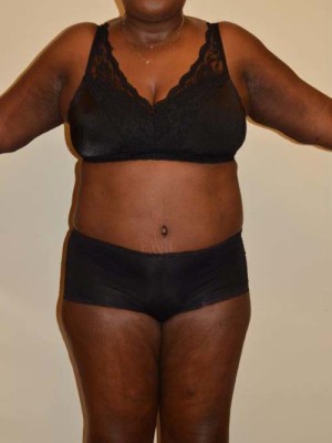 Tummy Tuck Case 13131 After Photo Tummy Tuck