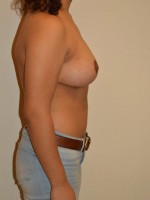 Breast Reduction