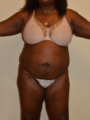 Liposuction Case 13134 Before Photo Liposuction
