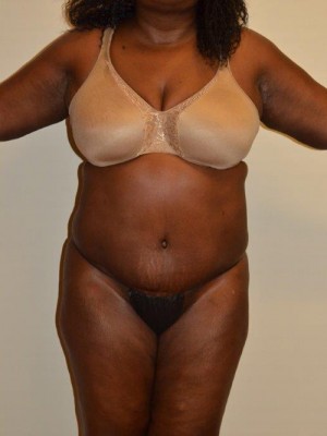 Liposuction Case 13134 After Photo Liposuction