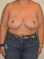 Breast Reduction