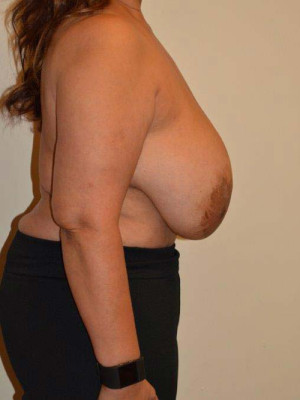 Breast Reduction Case 13182 Before Photo Breast Reduction