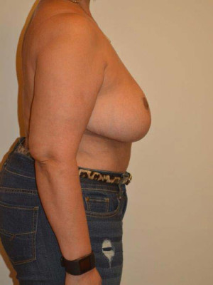 Breast Reduction Case 13182 After Photo Breast Reduction