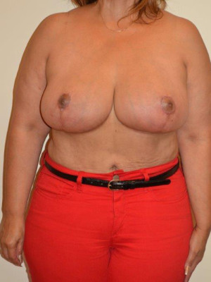 Breast Lift Case 13183 After Photo Breast Lift