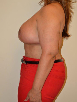 Breast Lift Case 13183 After Photo Breast Lift