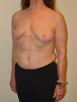 Breast Reconstruction