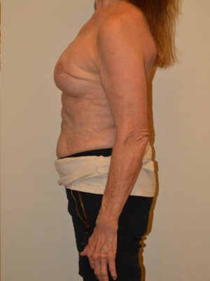 Breast Reconstruction Case 13185 After Photo Breast Reconstruction