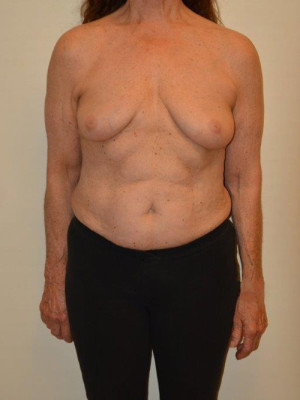 Breast Reconstruction Case 13185 Before Photo Breast Reconstruction