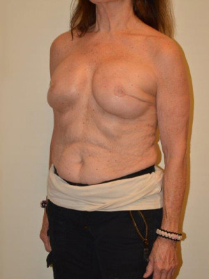 Breast Reconstruction Case 13185 After Photo Breast Reconstruction