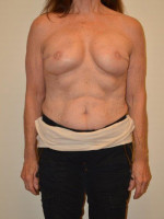 Breast Reconstruction