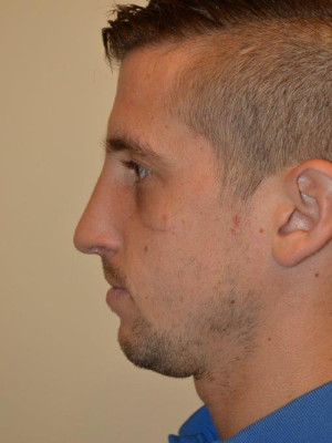 Nose Surgery Case 13186 After Photo Nose Surgery