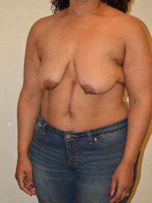 Breast Augmentation with Lift Case 13187 After Photo Breast Augmentation with Lift