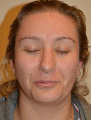 Nose Surgery Case 13260 After Photo Nose Surgery