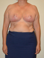 Breast Reduction