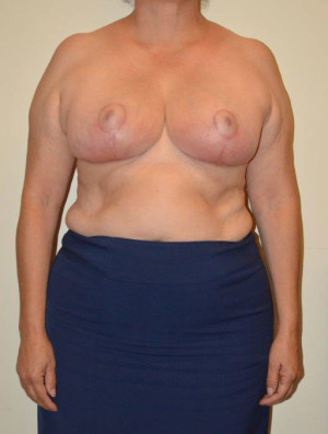 Breast Reduction Case 13331 After Photo Breast Reduction