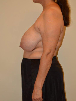 Breast Reduction Case 13331 Before Photo Breast Reduction