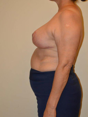 Breast Reduction Case 13331 After Photo Breast Reduction
