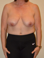 Breast Reduction