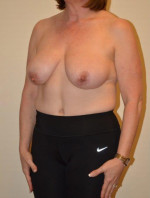 Breast Reduction