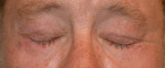 Eyelid Surgery