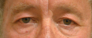 Eyelid Surgery Case 13307 Before Photo Eyelid Surgery