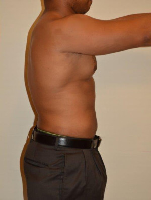 Liposuction Case 13349 After Photo Liposuction