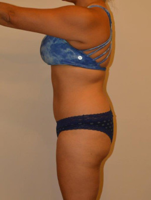 Tummy Tuck Case 13365 After Photo Tummy Tuck