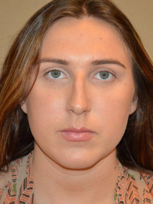 Nose Surgery Case 13373 Before Photo Nose Surgery