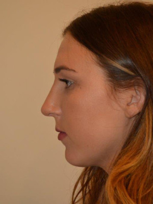 Nose Surgery Case 13373 After Photo Nose Surgery