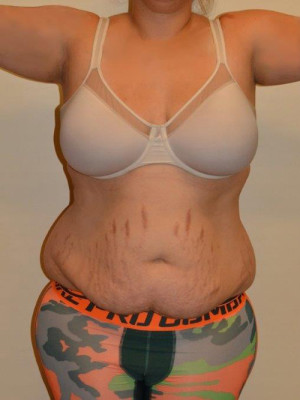 Tummy Tuck Case 13430 Before Photo Tummy Tuck