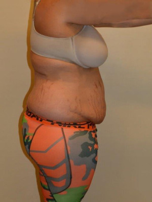 Tummy Tuck Case 13430 Before Photo Tummy Tuck