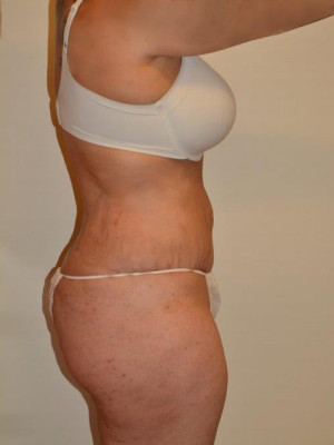 Tummy Tuck Case 13430 After Photo Tummy Tuck